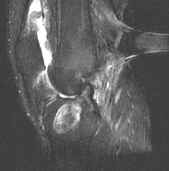 Figure 2 for case ACL graft complications